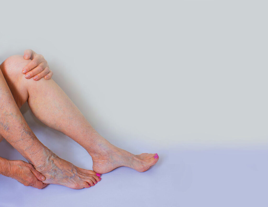 Senior woman touching ankle with visible varicose veins closeup