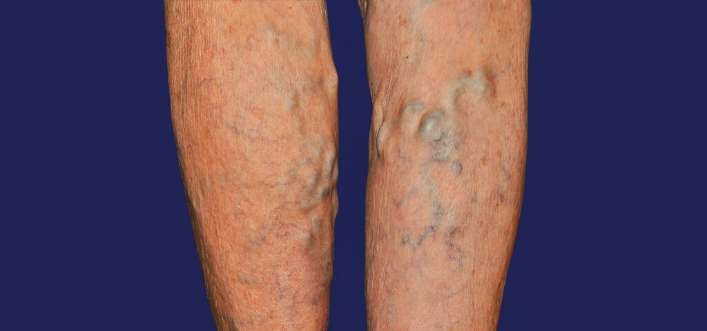 Close-up of both legs showing prominent varicose vein clusters