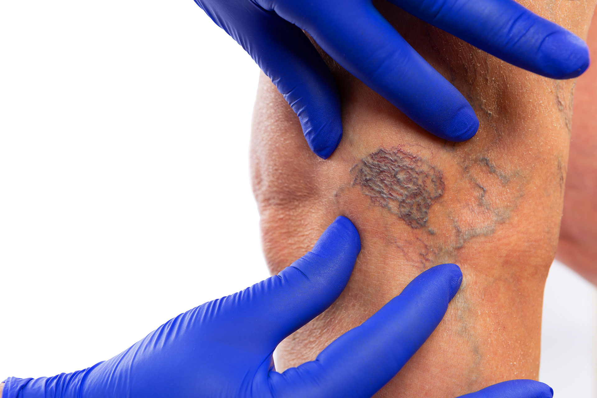 How to Get Rid of a Spider Vein Quickly, What Works
