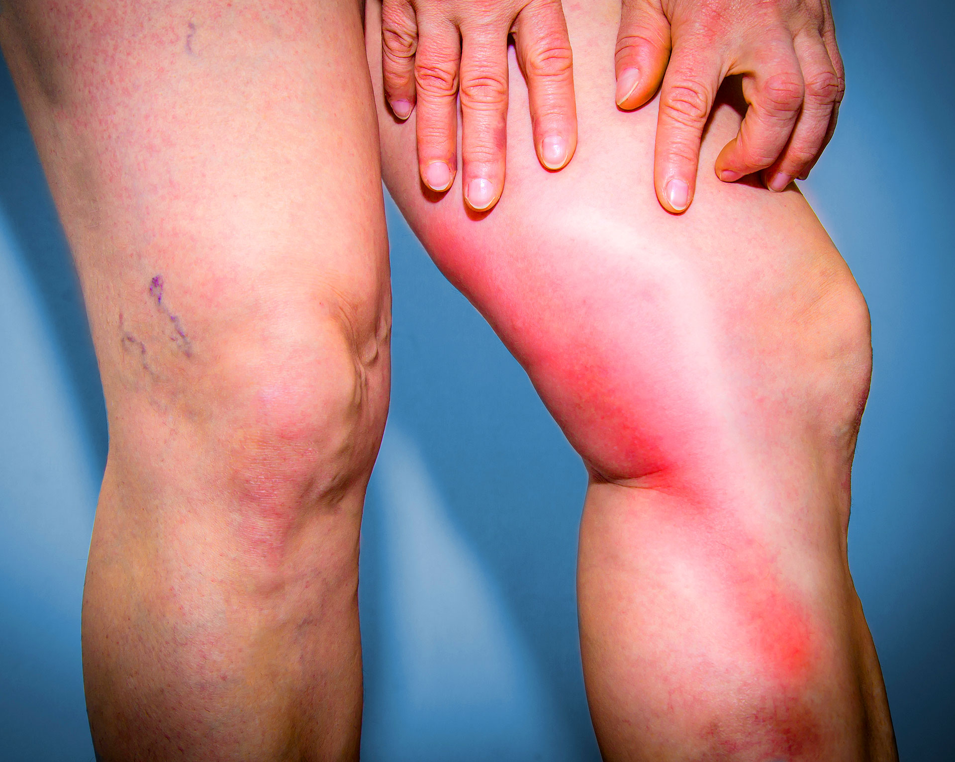 Phlebitis and What It Means for Your Vein Health