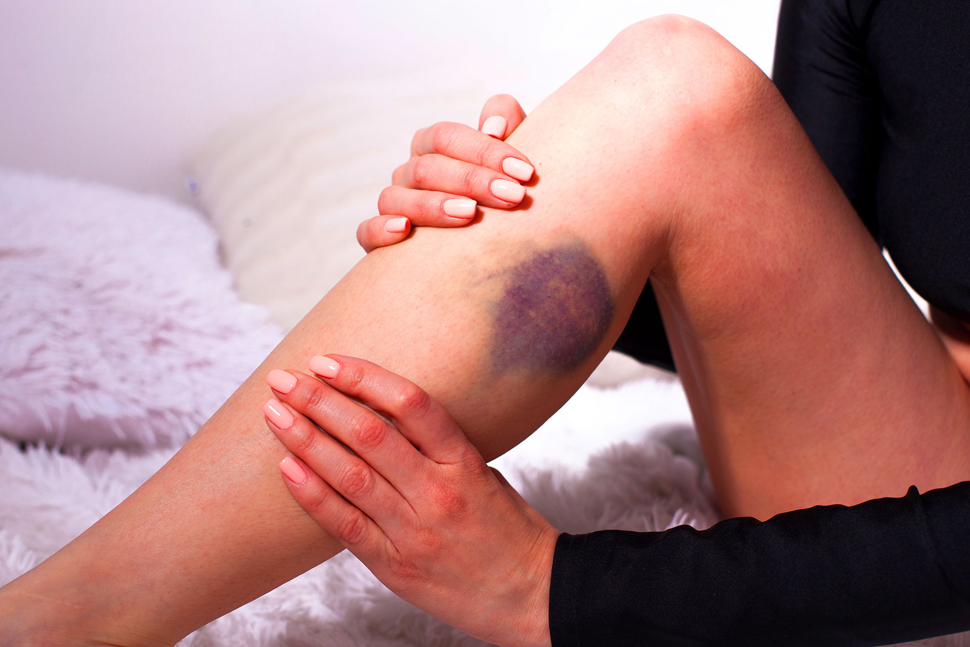 Bruises and Blood Clots in Legs: What’s the Difference