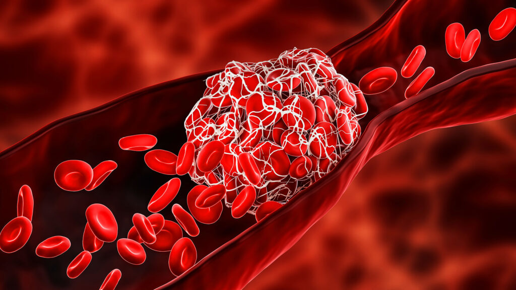 3D medical illustration showing a blood clot formation inside a red blood vessel.