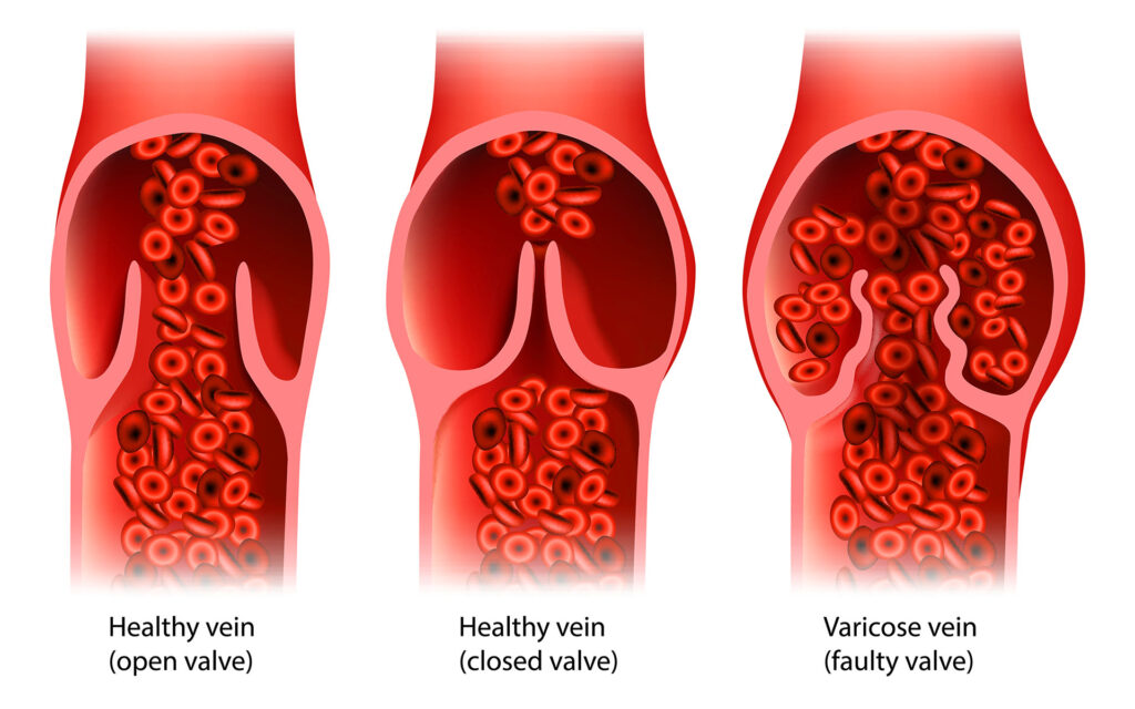 Medical diagram illustrating healthy veins with open and closed valves compared to a varicose vein with a faulty valve.