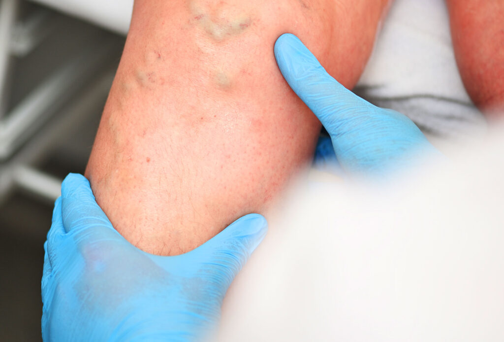 Doctor in blue gloves examining and palpating a patient's leg with visible varicose veins.