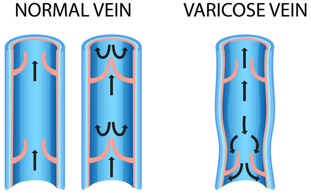 Diagram comparing normal vein function to varicose vein backflow