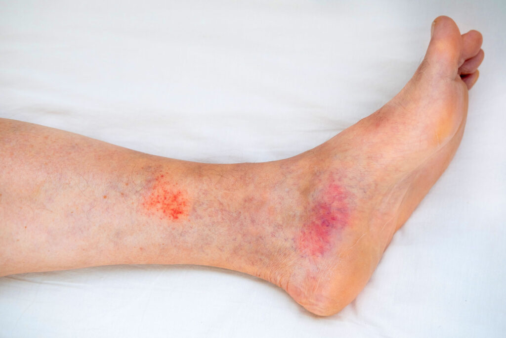 Close-up ankle showing bruising and skin discoloration from treatment