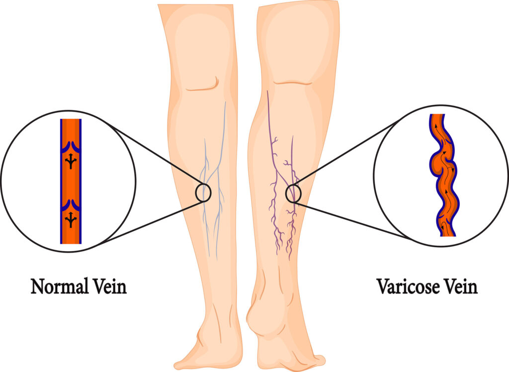 Illustration comparing normal veins to varicose veins in legs