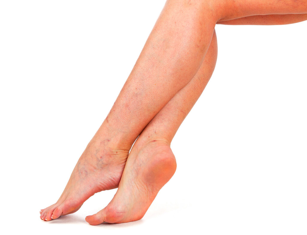 Lower legs and ankles displaying skin discoloration and mild surface vascular issues related to broken capillaries.