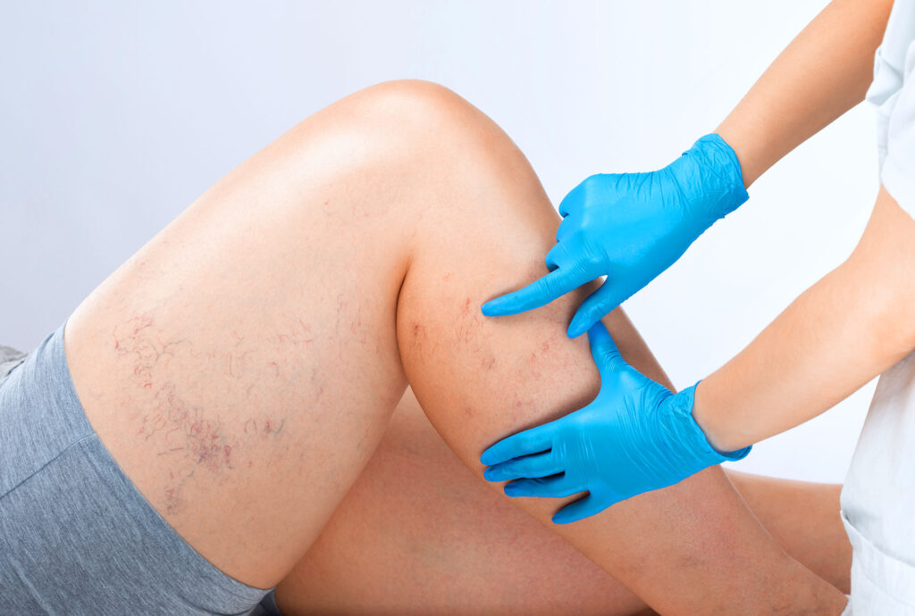 A medical professional in blue gloves examining broken capillaries and spider veins on a patient's leg.