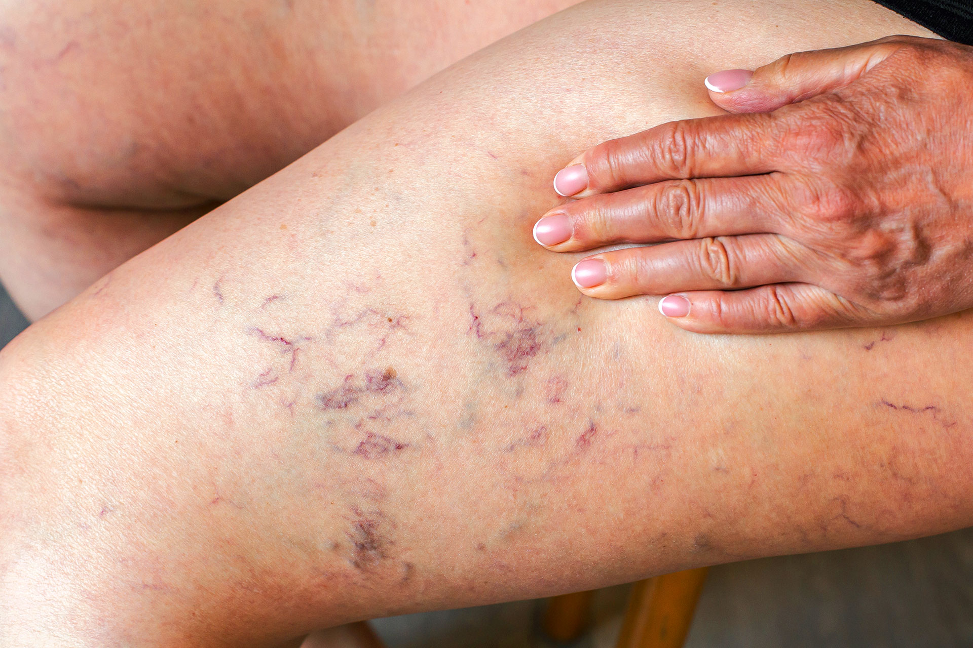 Why Do Blood Vessels Burst? Causes and When to Worry