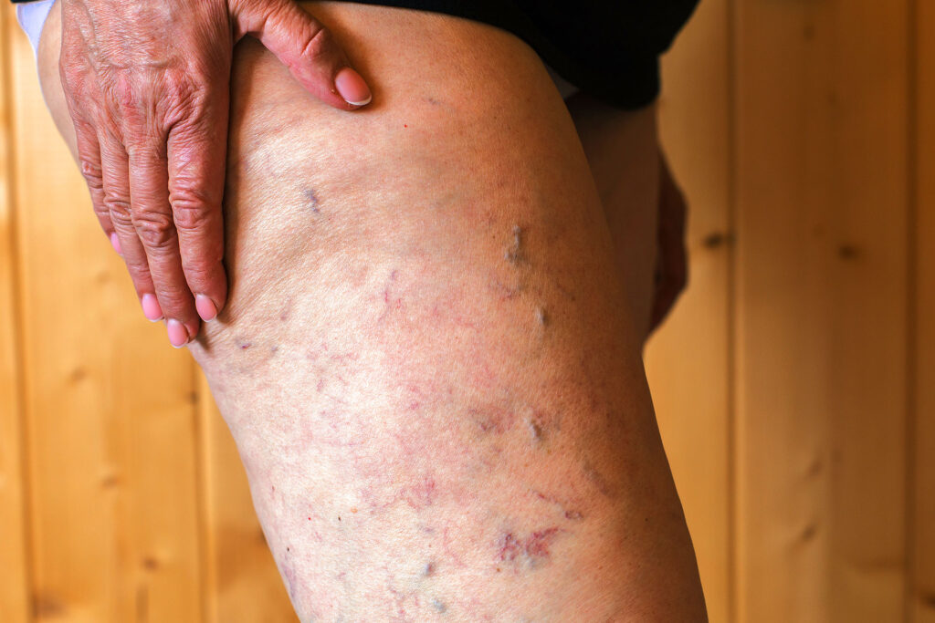  Side profile of a leg showing raised varicose veins and web-like marks where blood vessels burst near the surface.