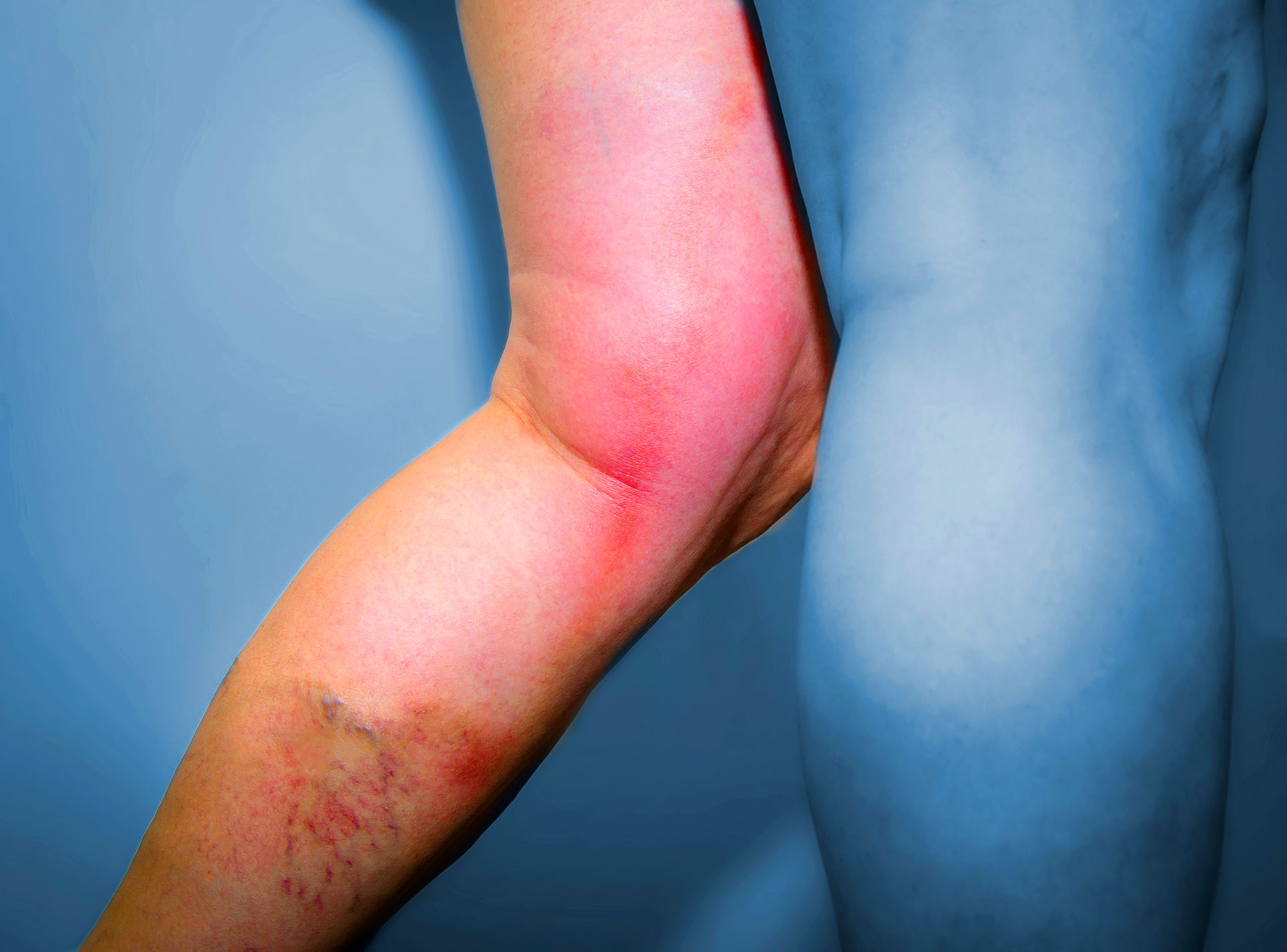 What Does Phlebitis Look Like? Signs to Watch For