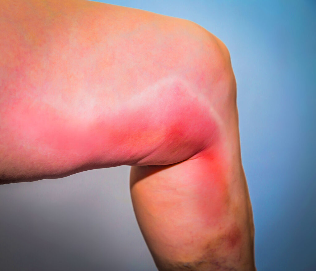 Skin swelling and discoloration from phlebitis.