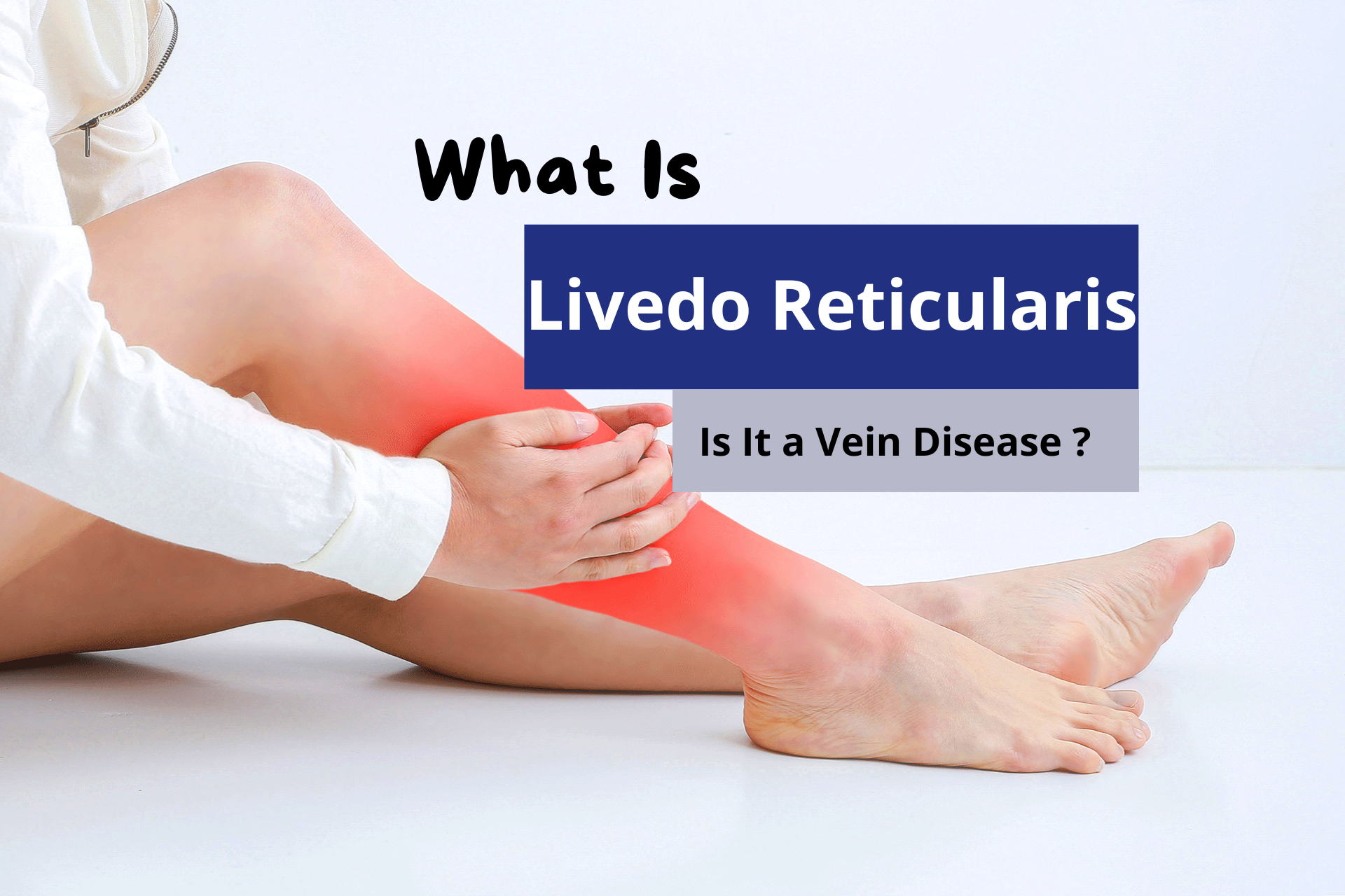 What Is Livedo Reticularis? Is It a Sign of Vein Disease?