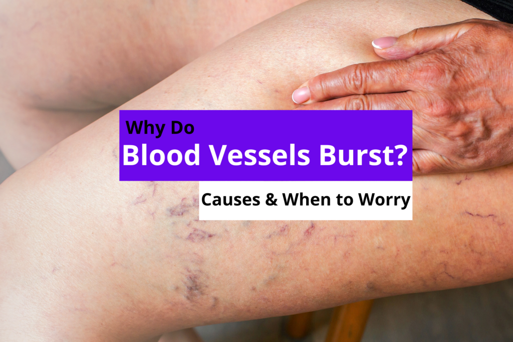 A close-up view of an individual's thigh showing clusters of red and purple veins, helping answer what happens when blood vessels burst under the skin.