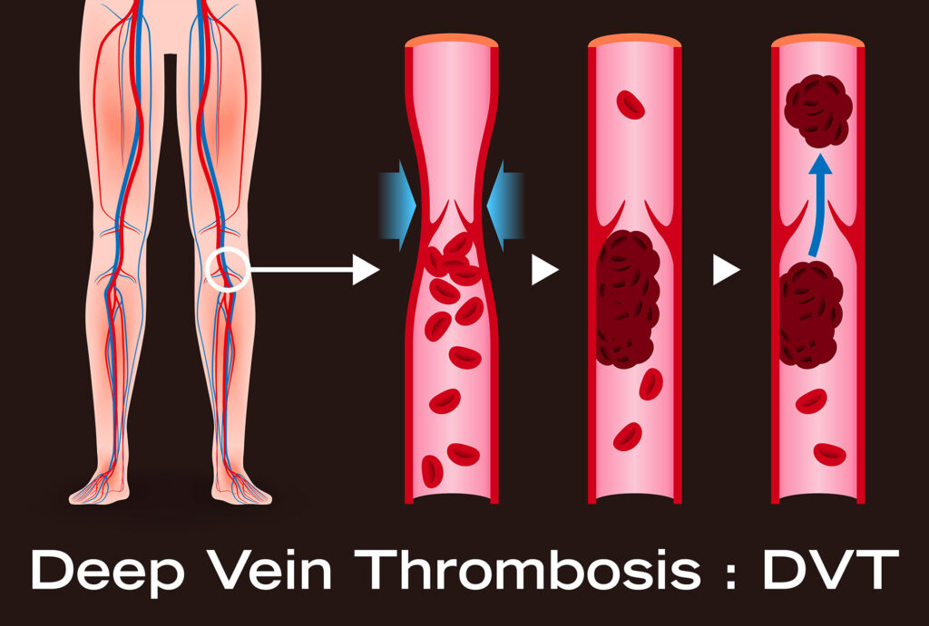 A medical diagram illustrating deep vein thrombosis alongside an anatomical view of veins, relevant to patients monitoring vascular conditions like spider veins.