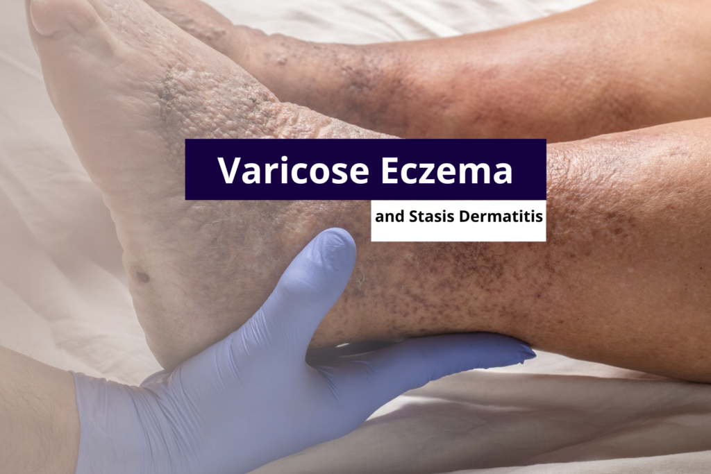 Medical professional in blue gloves examining severe skin pigmentation and texture changes on a patient's lower leg and foot associated with advanced varicose eczema.