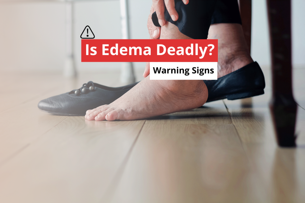 Close-up of a person holding a severely swollen foot next to a text graphic asking "Is Edema Deadly", addressing the question can edema kill you.