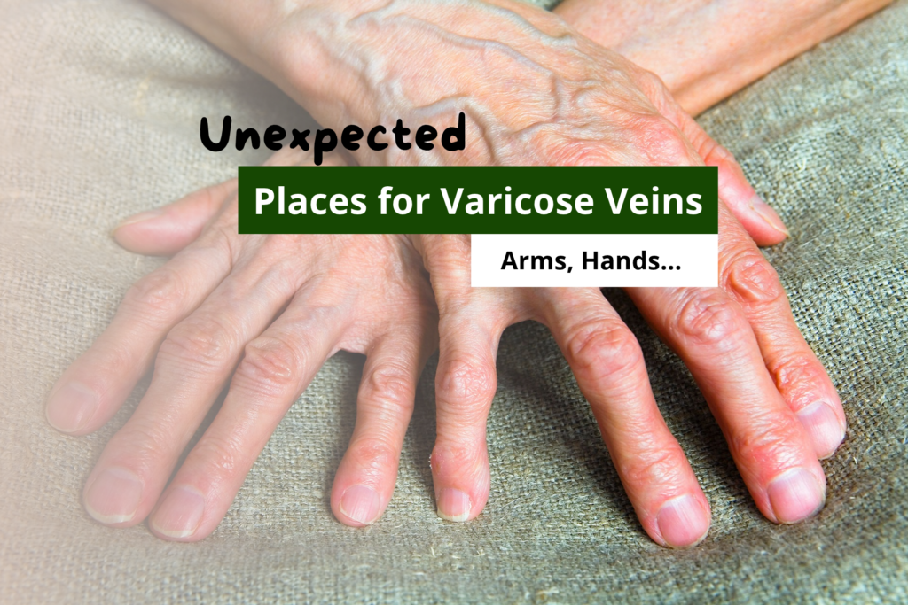 Close-up of elderly hands resting on a burlap fabric, highlighting prominent vascular texture and visible veins arms and hands.