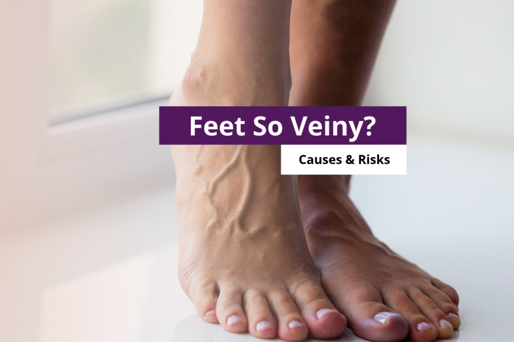 Close-up of a person's bare foot showing prominent, visible foot veins on the top of the foot.