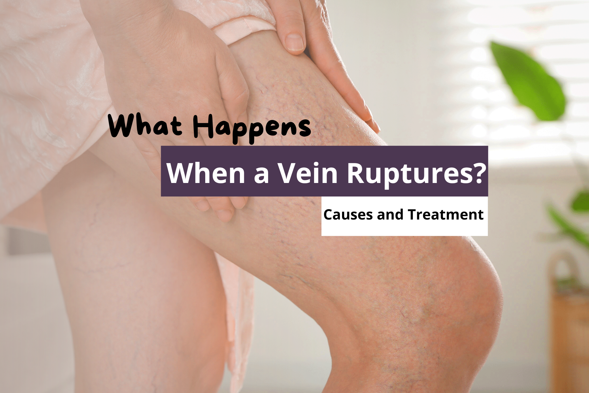 What Happens When a Vein Ruptures? Causes and Treatment