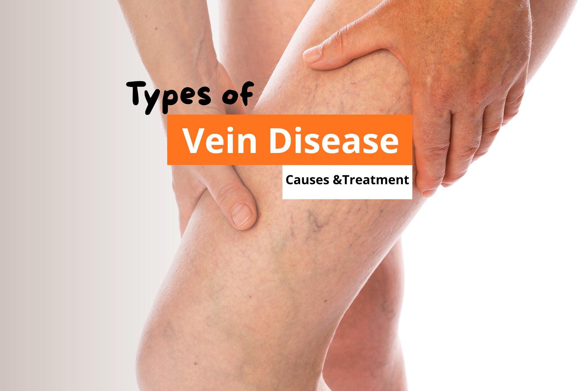 6 Types of Vein Disease You Should Know About