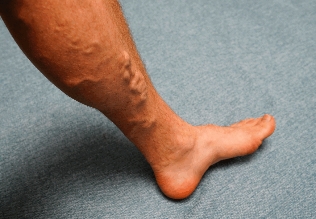 Detailed view of prominent varicose veins on a man's lower leg caused by Vein Disease.