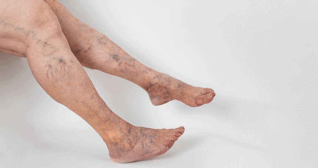 Detailed view of a person's legs showing prominent varicose veins and skin changes.
