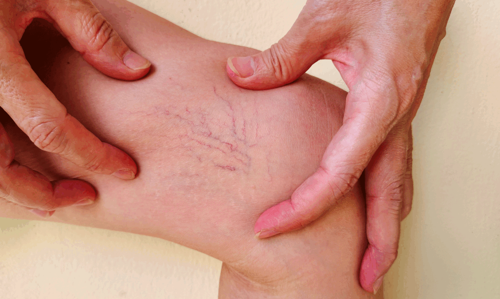 Close-up of hands examining the skin on a leg with visible superficial blood vessels and varicose veins.