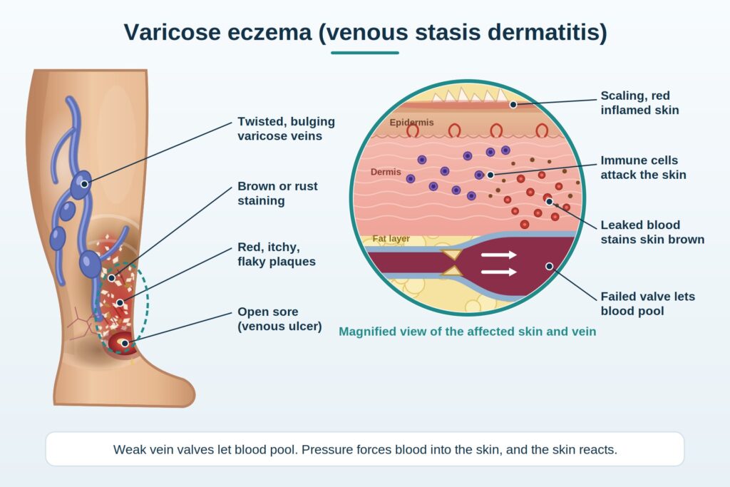 Medical illustration of varicose eczema showing bulging veins and skin changes